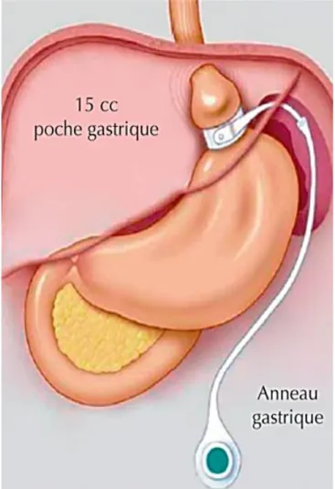 Figure tirée de Léveillé P, Sermondade N, Faure C, Catheline JM, Benchetrit S, Hercberg S, Czernichow  S,  Lévy  R