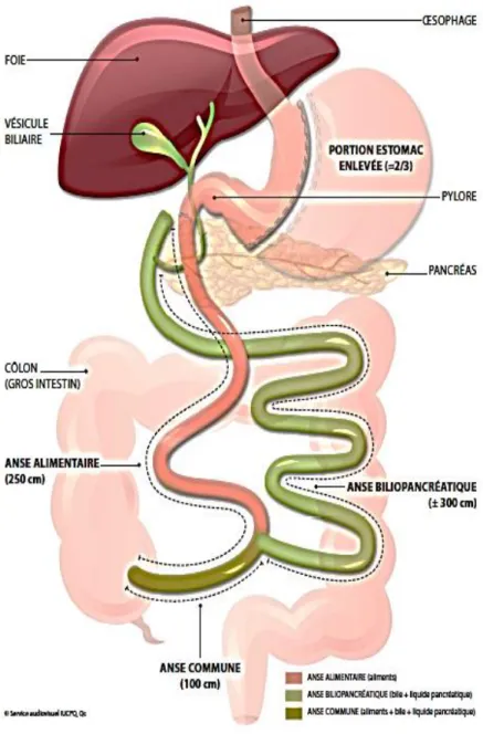 Figure tirée du site de l’Institut universitaire de cardiologie et de pneumologie de Québec  – Université  Laval   (http://iucpq.qc.ca/fr/soins-et-services/axes/obesite/programme-de-chirurgie-bariatrique/chirurgies-offertes)