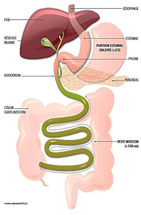 Figure tirée du site de l’Institut universitaire de cardiologie et de pneumologie de Québec  – Université  Laval  (http://iucpq.qc.ca/fr/soins-et-services/axes/obesite/programme-de-chirurgie-bariatrique/chirurgies  offertes)