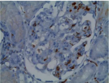 Figure 2 : Glomérulite : occlusions des capillaires glomérulaires par des éléments  mononucléés (x40, CD68), photo prise à partir de biopsie dans le SACP, CHUGA