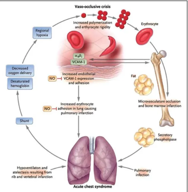 Figure 3 : Physiopathologie de la crise vaso-oclusive 