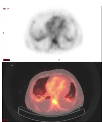 Figure 3. Atteinte scintigraphique pleuro- pleuro-pulmonaire  