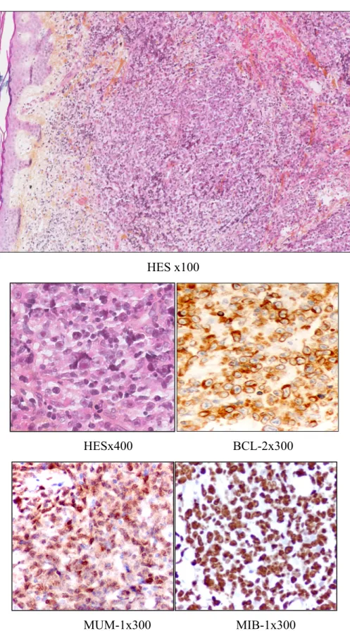 Figure 2 : Biopsies cutanées (HES et étude immunohistochimique) de LCBDGC-TJ 