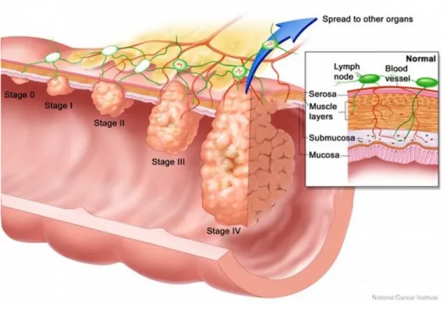 Figure 2 : Classification TNM des cancers colorectaux. Stade 0 : carcinome in situ, Stade I :  Tumeur envahissant la sous-muqueuse voire la musculeuse sans atteinte ganglionnaire,  Stade II : Tumeur envahissant la sous-séreuse sans atteinte ganglionnaire, 
