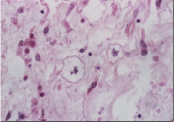 Figure   4   :   Leiomyosarcome   (image   issue   de   l’article   d’Avancès   et   al   Prog   Urol   2011(9))      