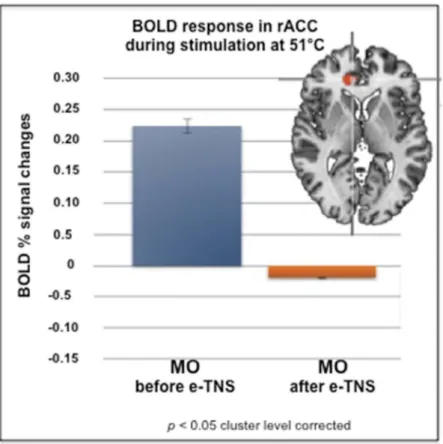Figure 2. BOLD responses induced in right ACC (Talairach coordinates (x, y, z: 12, 35, 7) by a thermo-nociceptive stimulus are increased in migraine without aura (MO) patients (n = 20) before eTNS