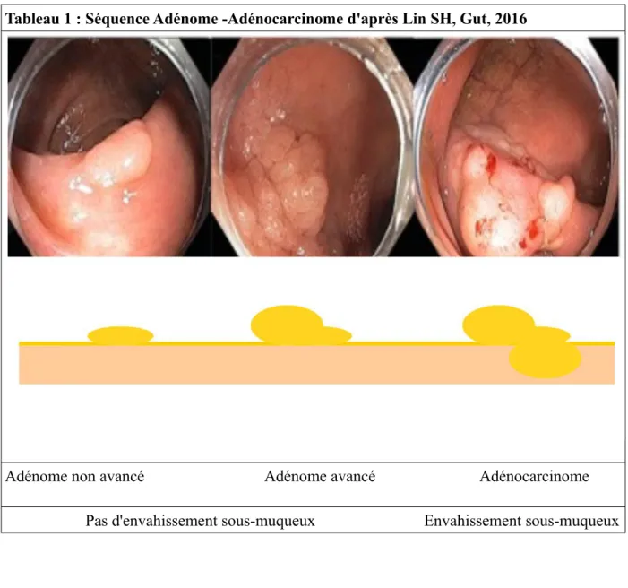 Tableau 1 : Séquence Adénome -Adénocarcinome d'après Lin SH, Gut, 2016