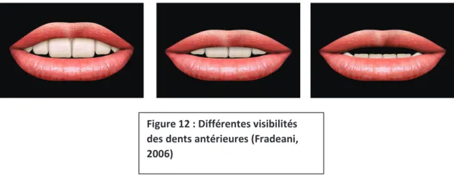 Figure 12 : Différentes visibilités  des dents antérieures (Fradeani,  2006) 