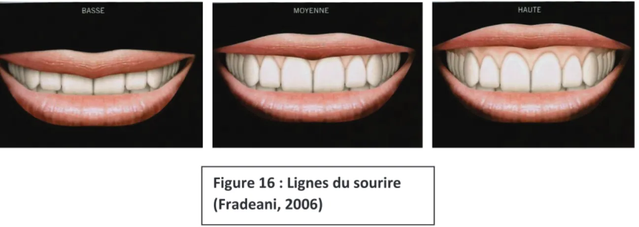 Figure 16 : Lignes du sourire  (Fradeani, 2006) 