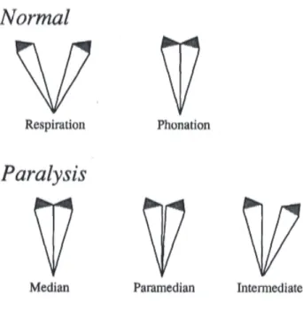 Figure 2 : Les positions possibles de la corde vocale dans le cadre d’une paralysie laryngée unilatérale 