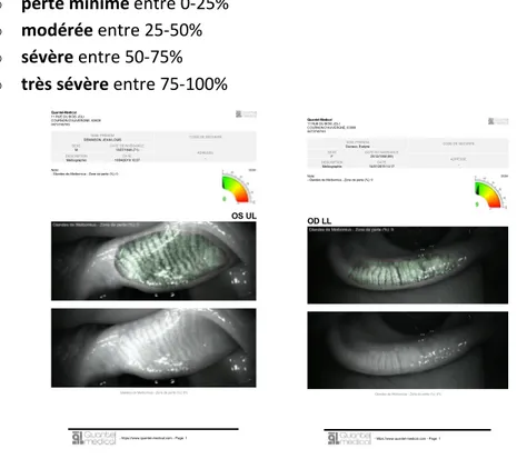 FIGURE 5.   Photographies de meibographie supérieure et inférieure  4.2 Étude du film lacrymal 