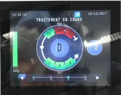 Figure 8. Interface du EyeOP1 en cours de procédure. Le secteur 1 est déjà traité, le secteur 12 est en  cours de traitement, les secteurs verts ne sont pas encore traités