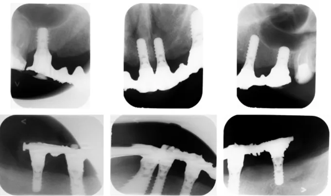 Figure 5 : Radiographies rétro-alvéolaires à 58 mois post-opératoire. 