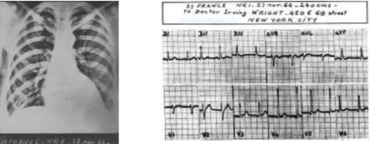 Figure 2 : radiographie de thorax et ECG transmis depuis le paquebot France à New York et  Paris le 27 novembre 1964
