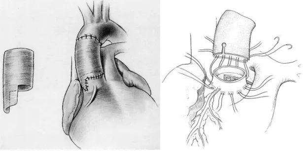 Figure I.B2-2 – Techniques sur le segment 0 sans réimplantation coronaire 