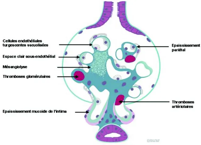 Figure 3: Lésions anatomo-pathologiques de la MAT, d’après le site diagnos.ardans.fr 