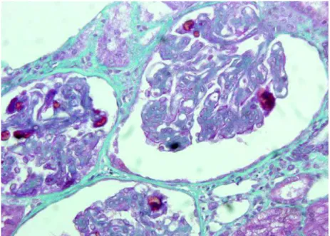 Figure 5: Thrombi des capillaires glomérulaires, d’après le site diagnos.ardans.fr 