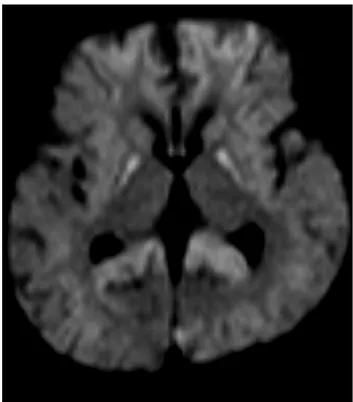 Figure  8.  IRM  cérébrale  d’un  cas  de  SHU  D+ :  hypersignaux  des  noyaux  gris  centraux  (noyaux  caudé  et  lenticulaire)  et  du  corps  calleux  témoignant  d’une  atteinte ischémique (séquence en diffusion) 