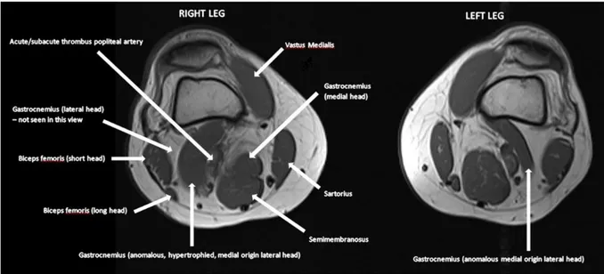 Figure 14 : exemple d'image IRM avec piège bilatéral par hypertrophie d’un faisceau aberrant du chef latéral  dont l’insertion est plus médiale que la normale au niveau de la tête médiale du condyle fémoral (20)chez un  homme de 47 ans présentant une isché