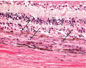Figure  7 :  Cellules  inflammatoires  (flèches  noires)    sur  coupe  histologique  d’une  rétine atteinte de DMLA (HES x 200)- (D’après Retina, 2014, Page 555.) 