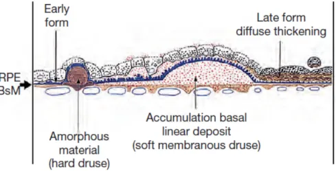 Figure  9 :  Schéma  montrant  les  rapports  entre  l’épithélium  pigmentaire,  sa  membrane  basale  et  l’accumulation  de  dépôts  au  cours  de  la  DMLA