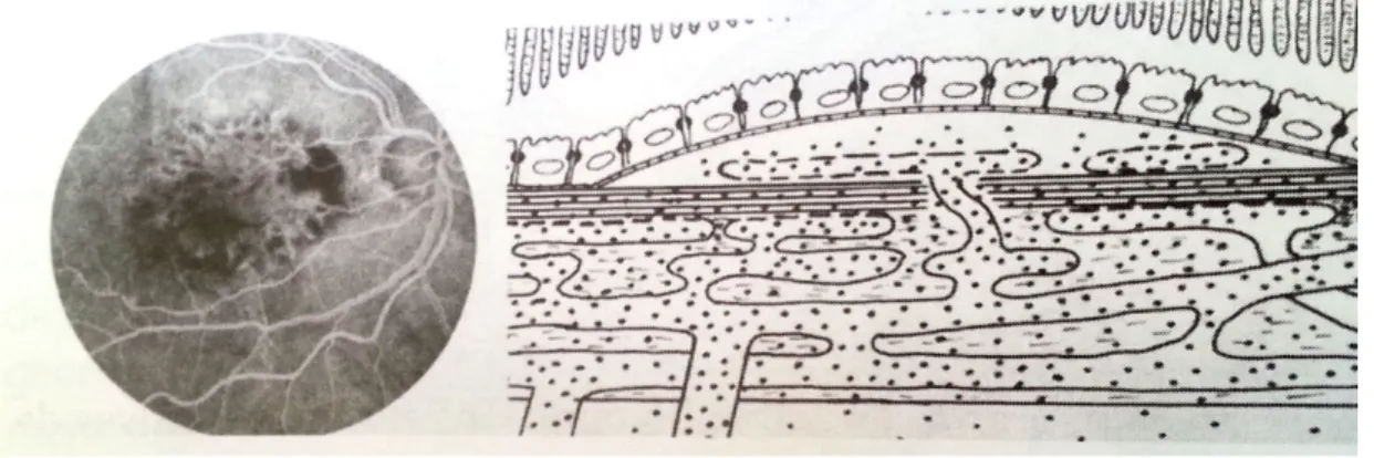 Figure 1 : Premier schéma d’un DEP vascularisé décrit par Gass en 1967 (2) 