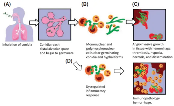 Figure 1. Physiopathologie de l’aspergillose invasive en fonction de l’état immunologique