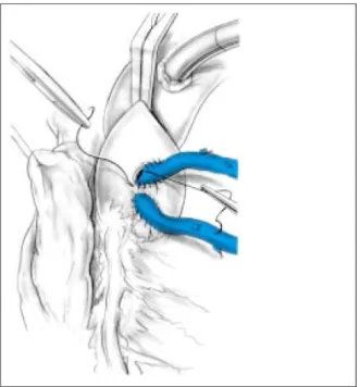 Figure 36. Anastomoses proximales de greffons saphène interne sous clampage aortique  complet