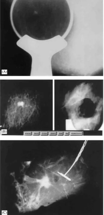 Fig. 2: (A) Spot compression view of the right breast of this 66-year-old woman confirmed a nonpalpable 6-mm  spiculated mass