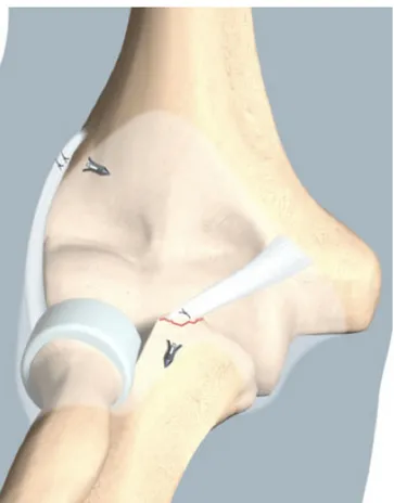 Figure 1 : Dessin représentant un coude droit de face après réinsertion du  plan capsuloligamentaire antéromédial, mise en place de la prothèse de tête  radiale et réinsertion du ligament collatéral latéral.(Dessin de Marc Donon) 