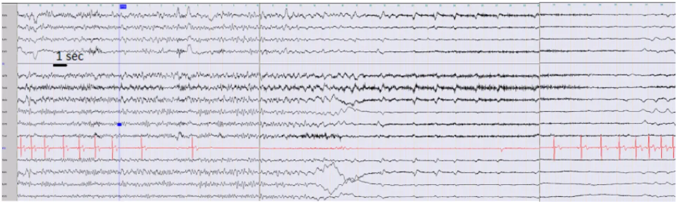 Figure 2 : Illustration d’une décharge rythmique qui précède l’installation d’une bradycardie  sur l’électrocardiogramme (ECG) puis d’une asystolie (Szurhaj 2019) 