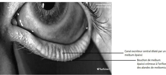 Figure   2 :  Meibographie   d'un   patient   avec   rosacée   oculaire   présentant   une   dilatation significative du canal central (voir flèches).