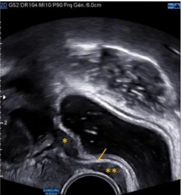 Figure 7 : Exemple de double localisation d’endométriose : 1 er  nodule du haut rectum (*) ; 2e  nodule de la cloison recto-vaginale (**)