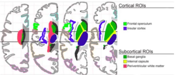 Figure 2 : Neuro-anatomie des localisations pourvoyeuses de troubles de la déglutition, Galovic et aL