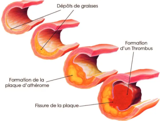 Figure 3: Evolution de la plaque athéromateuse 