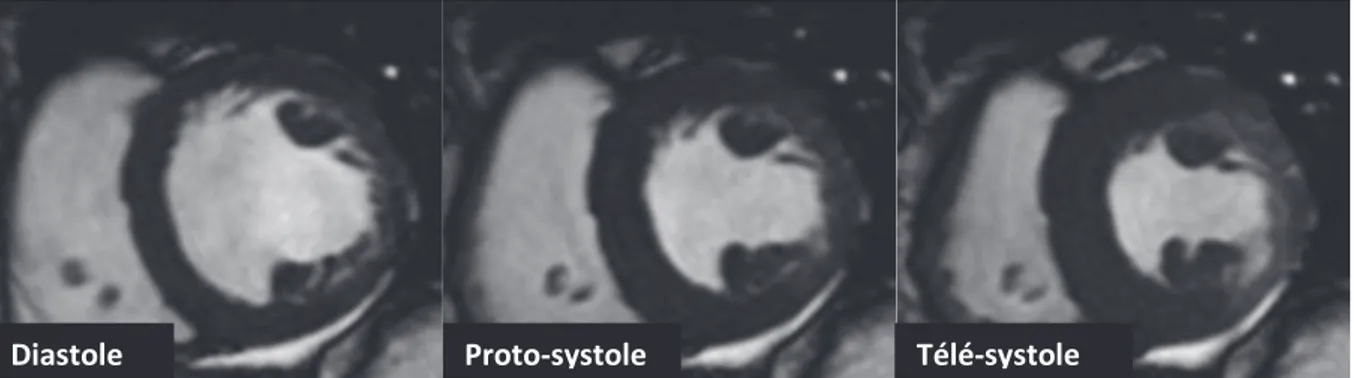 Figure 9: Séquence ciné TrueFISP SSFP dynamique en petit axe (infarctus aigu latéral) 