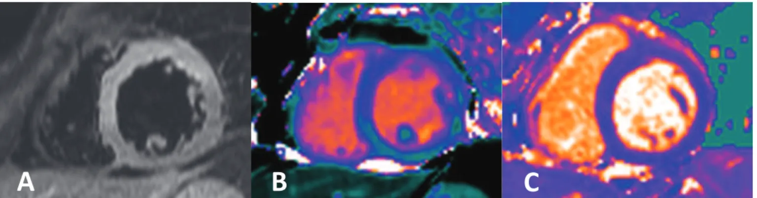 Figure 12: (A) Séquence T2 STIR, (B) Séquence T1 mapping, (C) Séquence T2 mapping en petit axe VG 