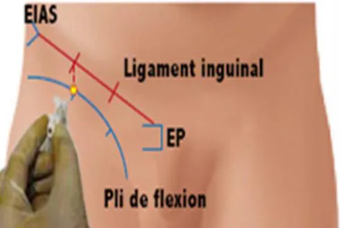 Figure 1 : Repères pour la réalisation du BIF. En jaune : point d’injection. [16] 