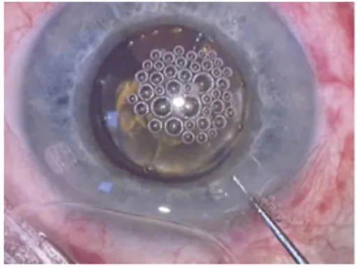 Figure 4 : Docking ou anneau de succion  du femtolaser type Victus ® : interface entre le patient et le  laser pour une bonne stabilisation oculaire du patient
