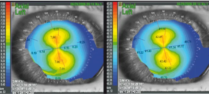Figure  12  :  Carte  de  topographie  spéculaire  axiale  de  l’OPD  Scan ®   d'un  patient  ayant  1D  d'astigmatisme direct
