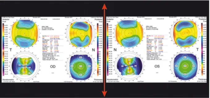 Figure 14 : Topographie type Orbscan : degré élevé d’énantiomorphisme 