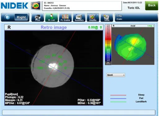 Figure 18 : Image acquise grâce au module &#34;toric IOL summary&#34; de l’OPD scan : vérification de visu  du positionnement de l'implant torique AT lisa toric de ZEISS