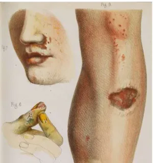 Fig. 3 Chromolithographie montrant les effets de l’arsenic utilisé  dans la fabrication de fleurs artificielles sur les visages, les mains  et  les  jambes  des  travailleurs,  dans  Maxime  Vernois,  1859