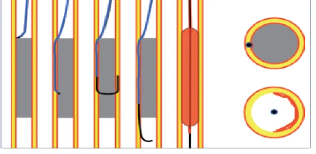 Figure 3. Recanalisation sous-intimale selon Bolia (3) 