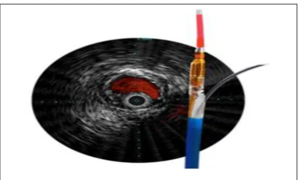 Figure 9. Système de réentrée avec IVUS : Pioneer 