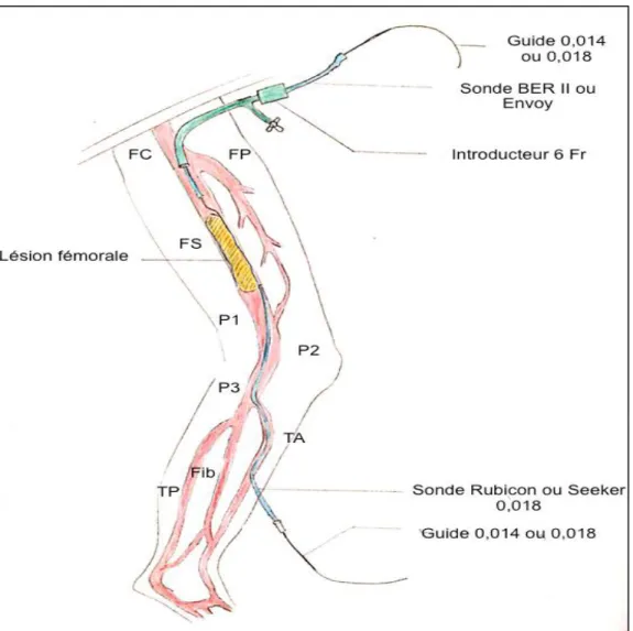 Figure 10. Schéma descriptif de la technique de SAFARI. (FC : fémorale commune; FP : fémorale  profonde ; FS : fémorale superficielle; P : poplitée; TA : tibiale antérieure;  Fib : fibulaire;           