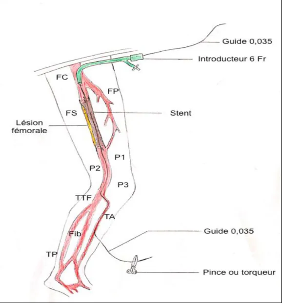 Figure 11. Schéma du téléphérique avec mise en place de stent (FC : fémorale commune;  FP :  fémorale profonde ; FS : fémorale superficielle; P : poplitée; TA : tibiale antérieure; Fib : fibulaire; 