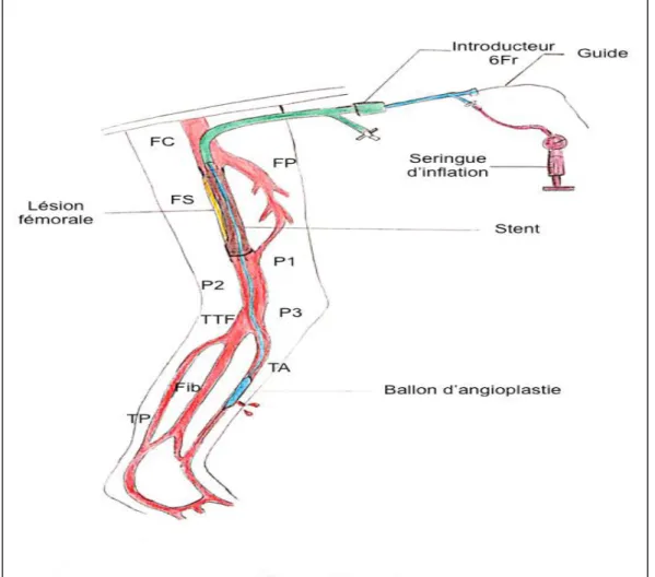 Figure 12. Hémostase endoluminale du point de ponction rérograde (FC : fémorale commune;  