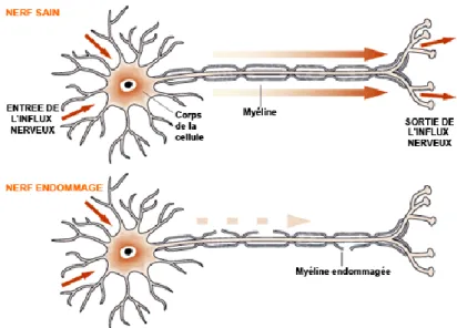 Figure 1: Schéma de comparaison entre un nerf sain (en haut) et un nerf endommagé (en bas) 