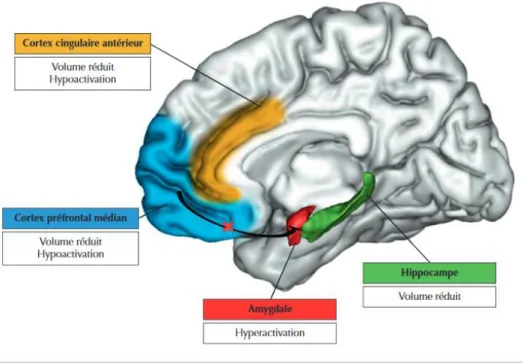 Figure  4: « Altérations cérébrales fonctionnelles et anatomiques liées à l’état de stress post-traumatique (ESPT) chez  l’adulte »  